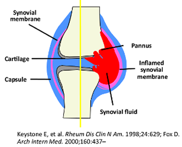 Rheumatoid arthritis - Knee