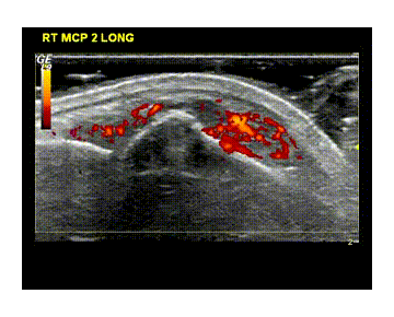 Rheumatoid arthritis - Synovitis